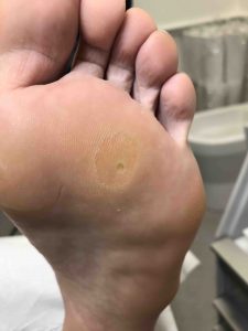 Woman's sole of foot with large callus